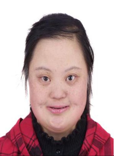 马芸莉出生在陕西延安,一出生她就被诊断患有先天性心脏病,先天愚型