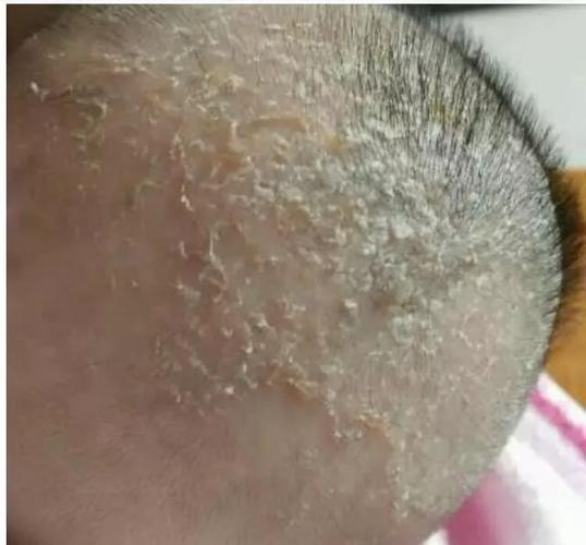 如何正确去头垢?这4个方法