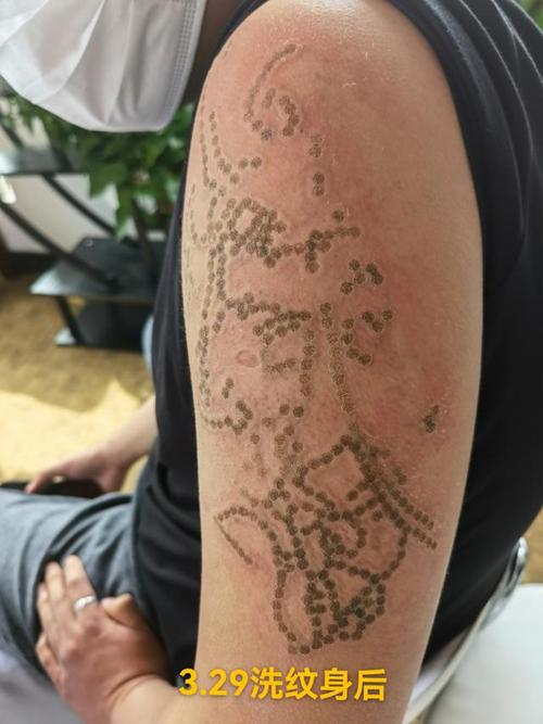 洗纹身后的护理一冰敷