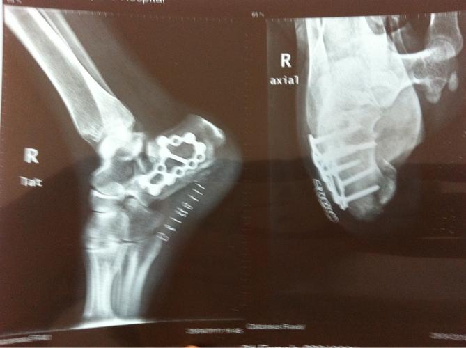 请问我的这种跟骨粉碎性骨折如何康复才能最大的降低创伤性关节炎的