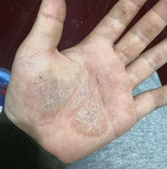 手掌皮肤硬化的手湿疹图片