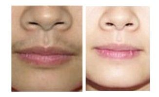 脱唇毛成功案例