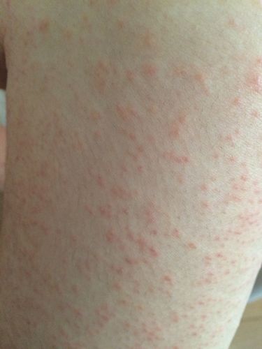 我一个多星期之前大腿内侧开始出现一片红点,超级痒那种,开始没在意就