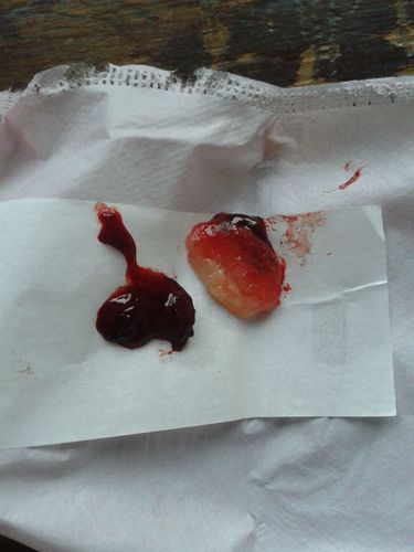 流产后胚胎掉下来是什么样?