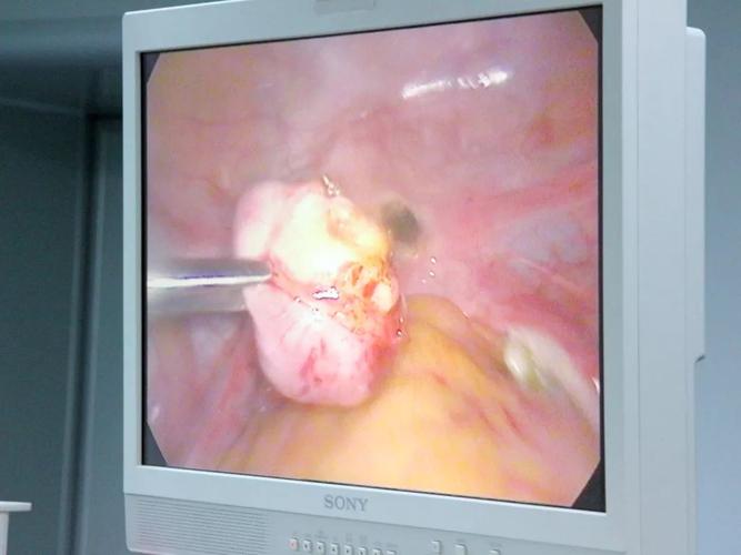 公益微创丨卵巢囊肿伴子宫肌瘤,常德首例免费微创手术