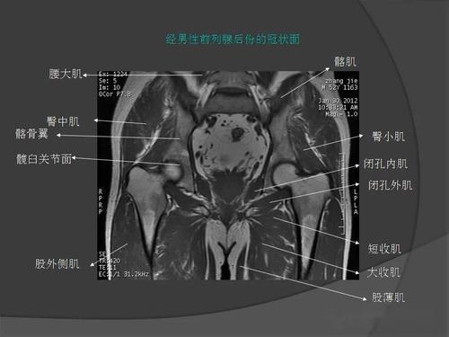 骨盆肌肉mri断层解剖