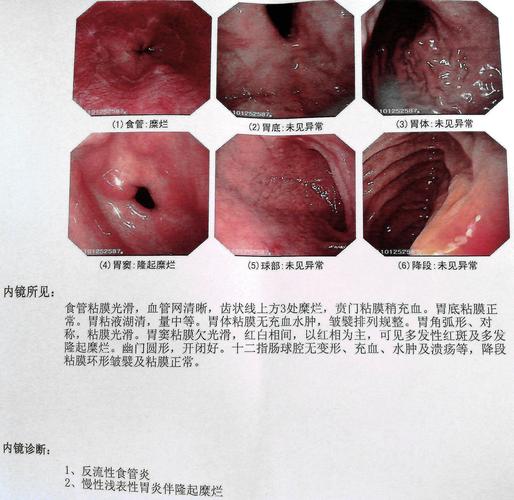 哪位医生网友帮忙分析看胃镜.胃溃疡图