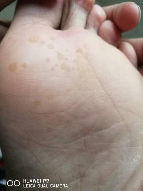 脚底起黄褐色的斑点是怎么回事?