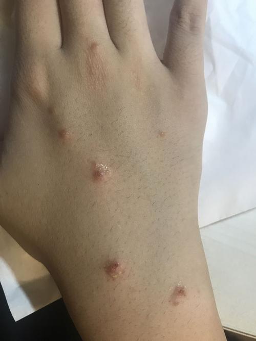 想问下这到底是什么皮肤病?湿疹吗?