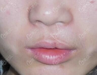 做兔唇修复手术已经很多年了留下的疤痕非常明显还能去掉吗