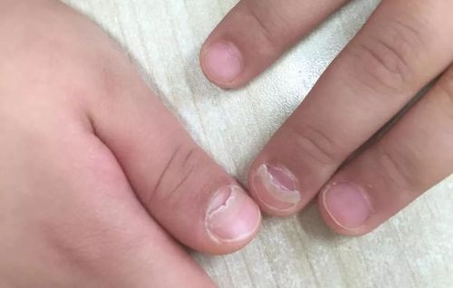 好妈日历小伢指甲脱落是要拔的灰指甲