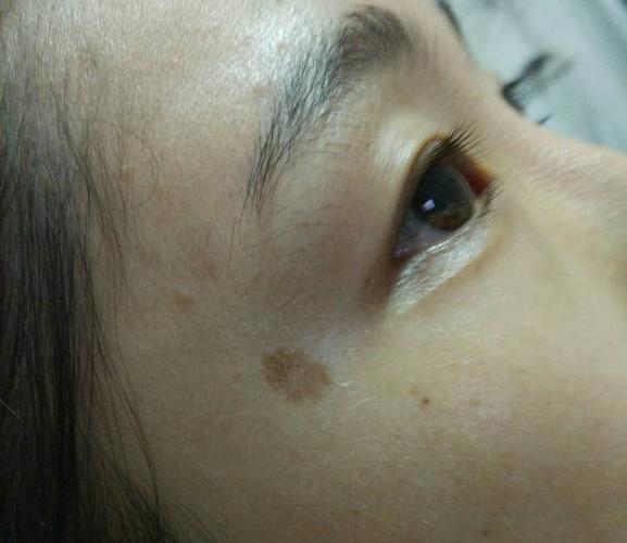 眼角的斑越来越大了怎么办啊?