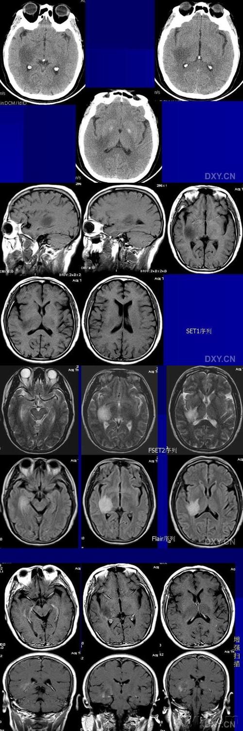 脱髓鞘假瘤临床常以急性起病为主, 为脑实质孤立性或多发性占位性病变