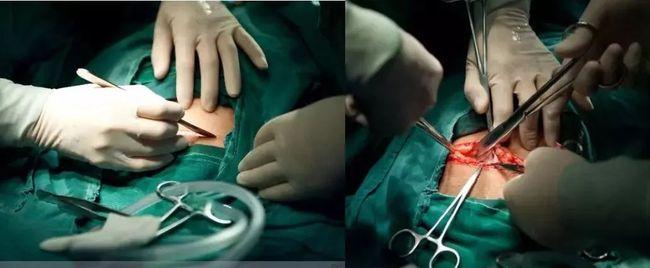 同样是挨一刀顺产侧切和剖腹产区别有多大