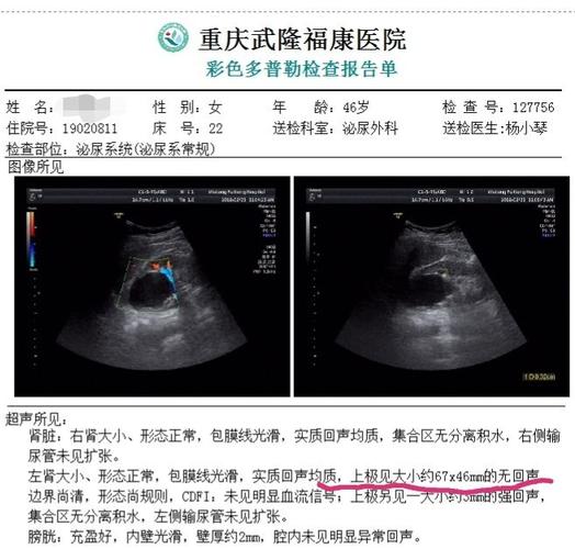 近日我科收治了一名中年女性肾囊肿患者,术前彩超提示左肾上极近7cm