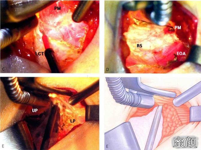乳房下皱襞切口隆胸术!
