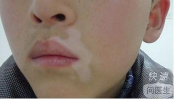 最近小孩脸上有些发白是什么情况