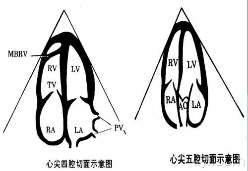五,心尖四腔及五腔切面     探头放在外下,声束指向右肩,显示十字