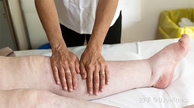 你有淋巴水肿