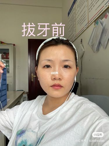 拔四颗正畸牙后的对比图_牙齿矫正_美妆_医美整形