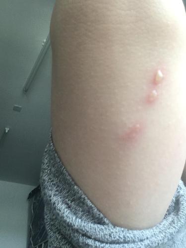 这是被隐翅虫咬的嘛