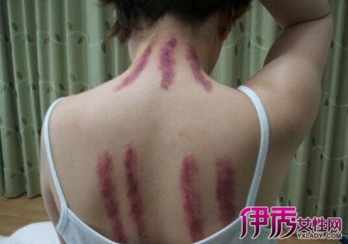 【图】刮痧时刮出痧的图片分享 出痧与不出痧的原因具体解析