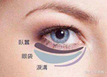我这个是眼袋还是卧蚕?