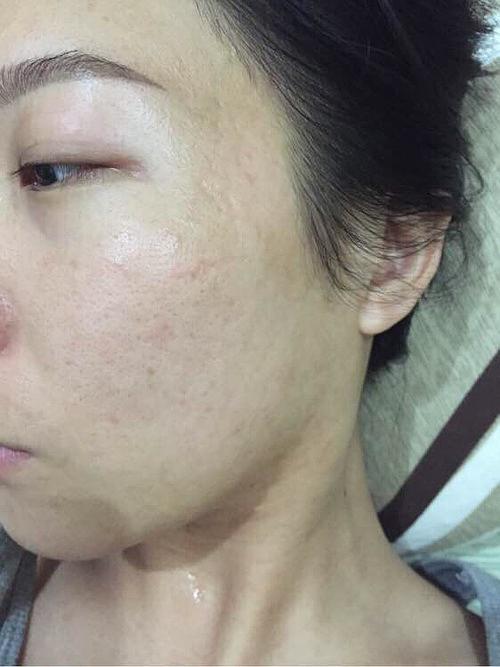 n多年的痘痘,痘坑,血泪史,做过各种医美治疗,交.