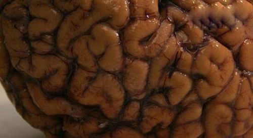 看福氏耐格里变形虫食脑虫如何吃掉大脑