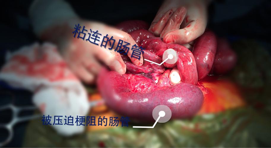 如何治疗肠粘连,肠梗阻?