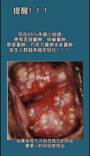 宫颈囊肿,纳囊,女孩子一定要注意了_备孕_宫颈多发纳氏囊肿卵巢囊肿