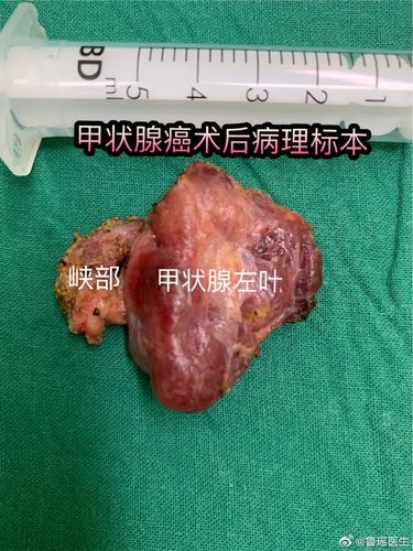 两位年轻患者都是一侧甲状腺癌为什么一位选择甲状腺半切而另一位选择