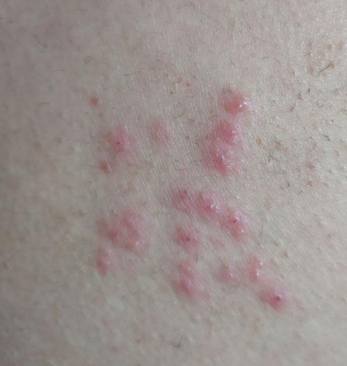 我得了带状疱疹的全过程