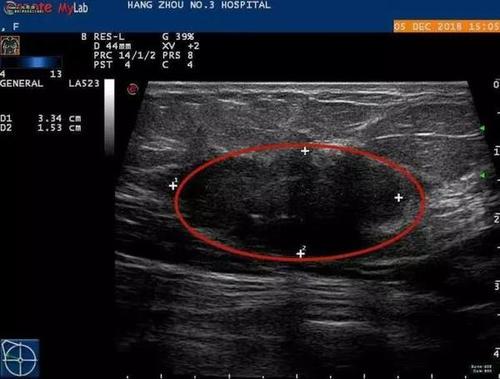 红色圈圈位置为乳腺癌肿块               2