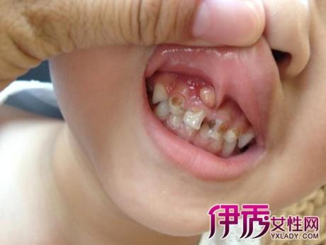 【图】牙齿旁边长了个肉疙瘩怎么办 医生说很可能是根尖脓肿