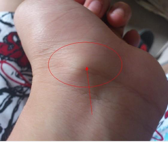 手腕内侧关节骨头凸起(游泳的时候爬上岸边不小心压到鹅卵石了) 但是