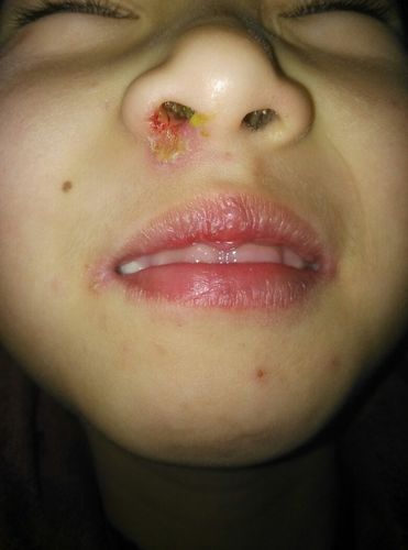 七岁小孩经常睡电热毯,导致上火,鼻子不通,有鼻涕,结壳子,其他都好,该