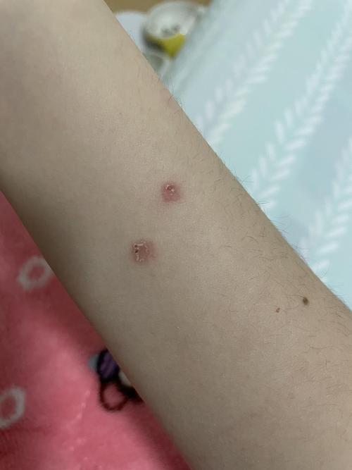 求助这是被猫癣传染了吗