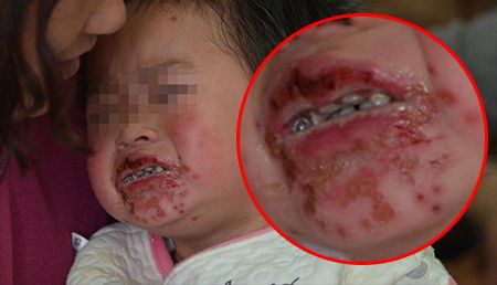 2岁女童吃辣条导致嘴巴溃烂