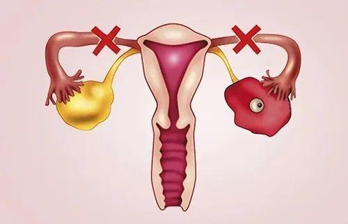 卵巢早衰的检查你知道吗