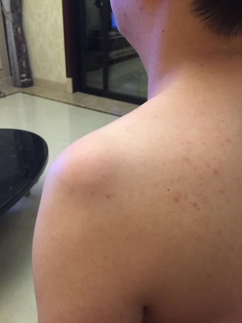 肩膀上鼓出一个包,不痛不痒,见照片,请专业人士看看是什么?谢谢帮忙