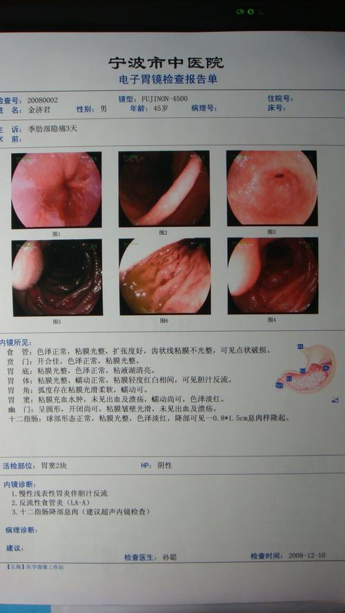电子胃镜诊断消化道早期肿瘤的新技术-富士能智能电子