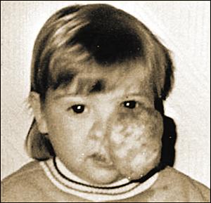 女孩半张脸长肿瘤19次手术除瘤找到意中人图