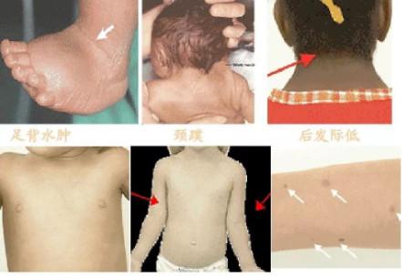 你了解turner综合征吗?