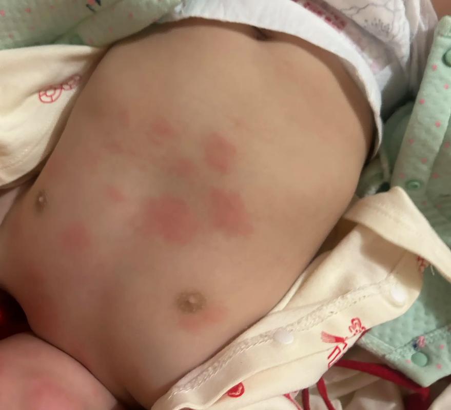 红疹 宝宝8个月,今天带孩子打了麻腮风和乙脑,晚上身上就出