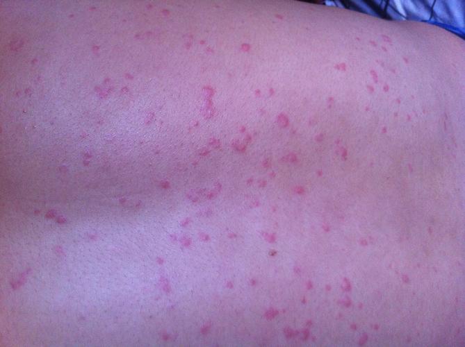 问:全身长红色斑点,特别是吃饭后长好多还有晚上睡觉时,不疼不痒.