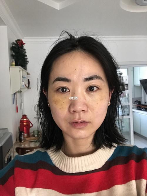 上海九院内切眼袋_眼袋_美妆_医美整形