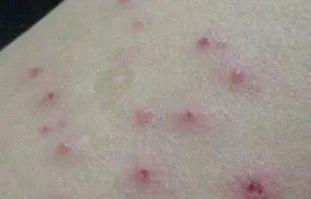 湿疹是因为皮肤太"潮湿"了吗?发病原因是什么?