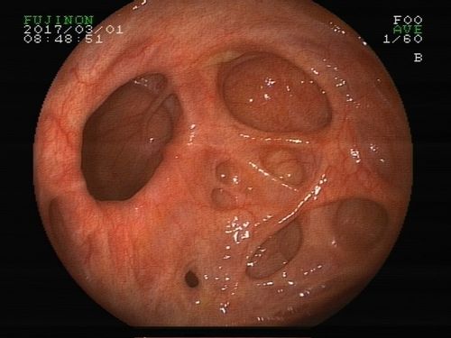 高纤维饮食减少结肠憩室病的发生
