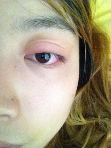 左上眼皮肿,用手摸,有点疼,已经两天了